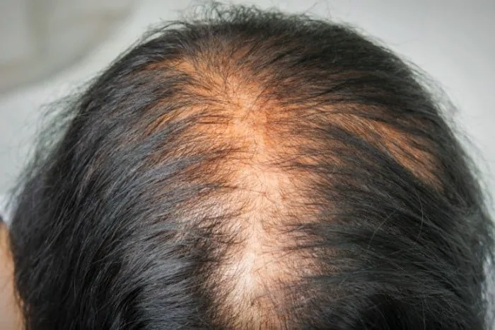 دلیل ریزش مو نوجوانی