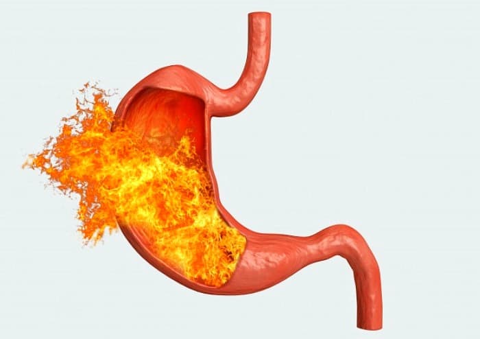 ریفلاکس معده در ویروس ایدز علائم ایدز