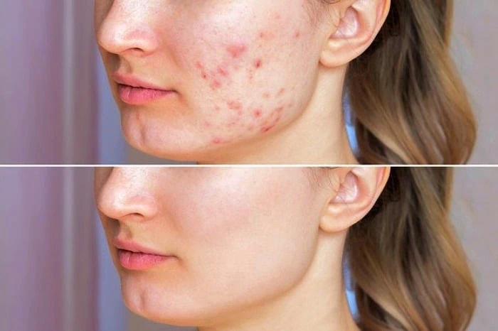  چگونه آکنه صورت را با تخم مرغ از بین ببریم