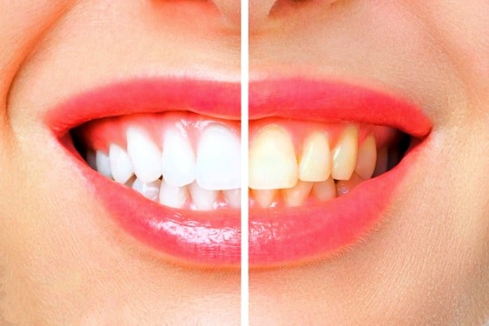 روش سفید کردن دندان 