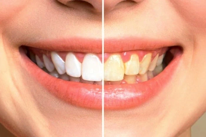 بلیچینگ برای دندان