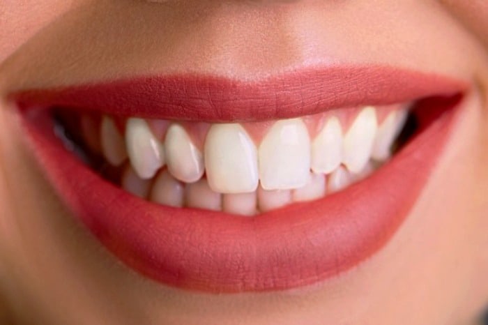 راه حل سفیدکردن دندان ها