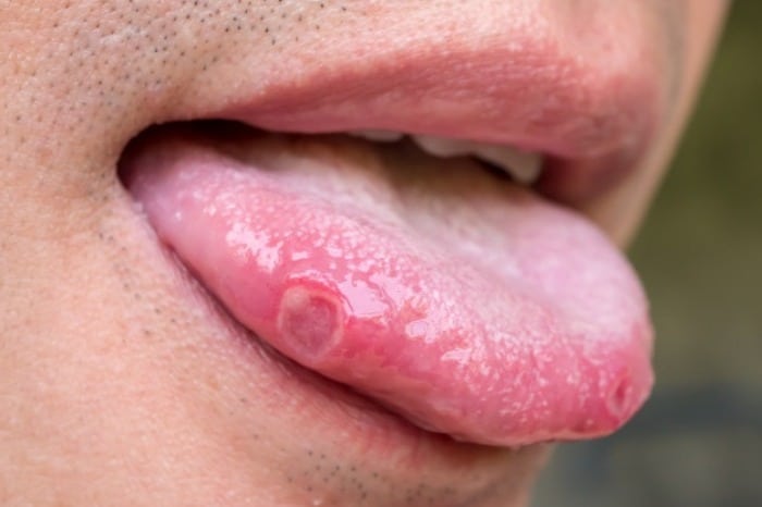 شکل سرطان زبان