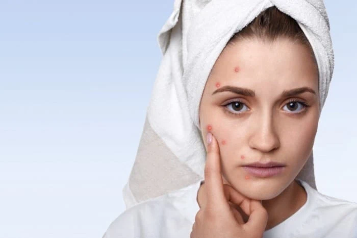 معجزه تخم مرغ در از بین بردن آکنه صورت