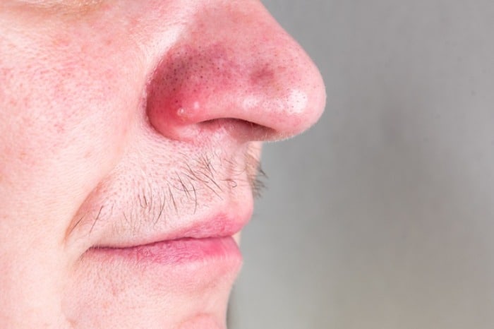 درمان سریع جوش روی بینی با بهترین ماسک های خانگی