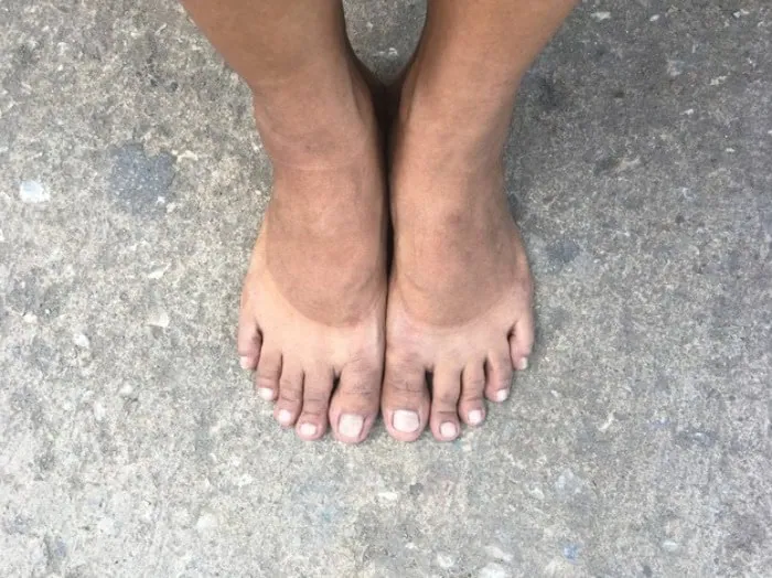 آفتاب سوختگی