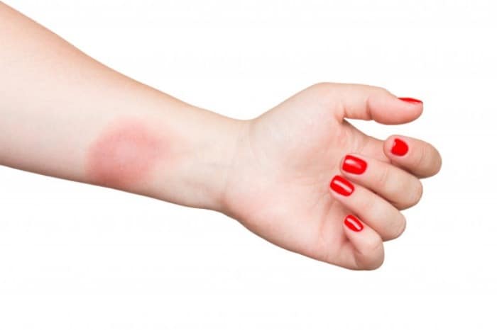 درمان انواع سوختگی های پوست