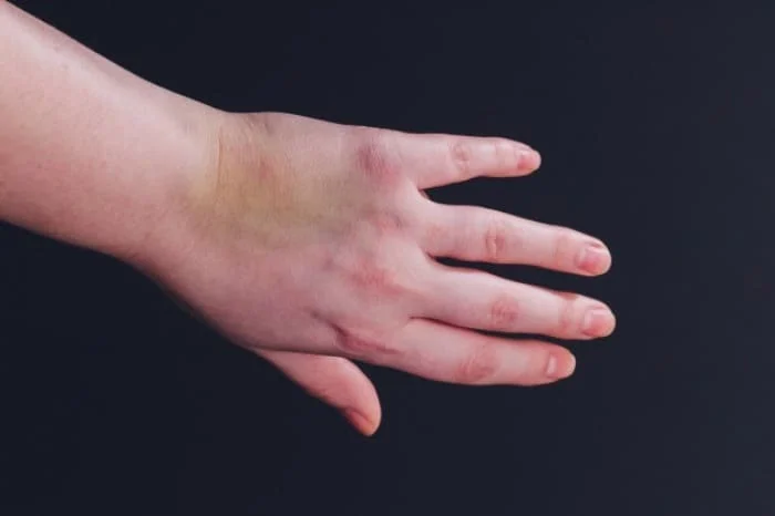 مضرات طب سوزنی