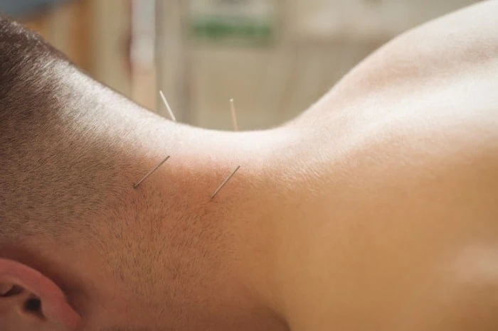 طب سوزنی درمان چاقی