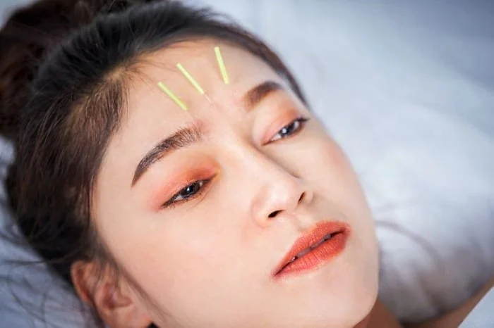 استفاده از طب سوزنی به جای بوتاکس