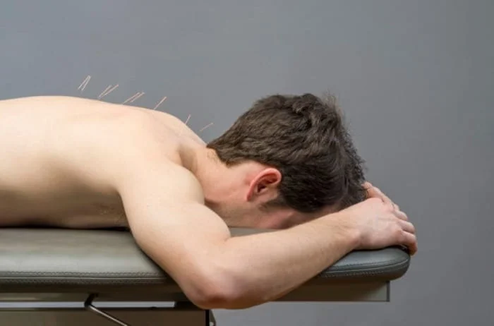 طب سوزنی سیاتیک