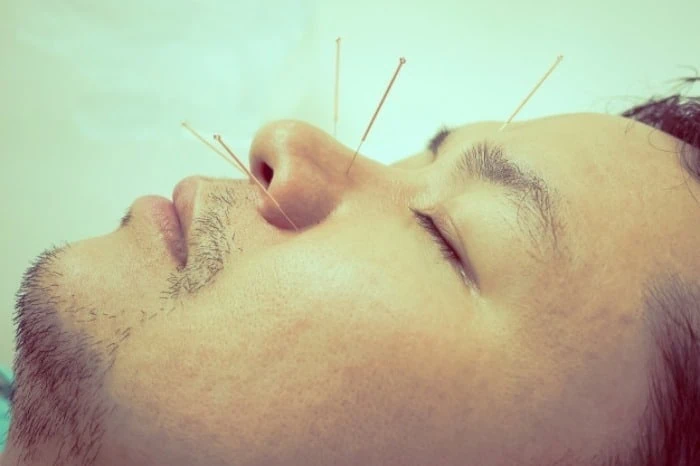 طب سوزنی