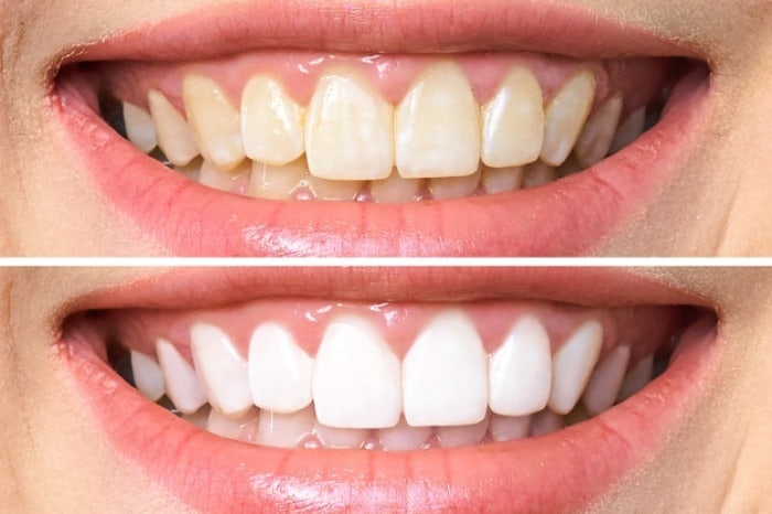 سفیدکردن دندان با سرکه
