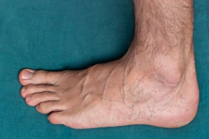 Varicose 