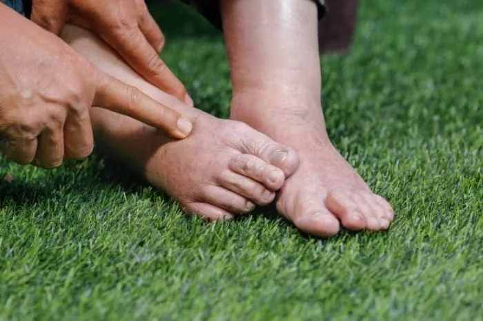علت احتباس آب در بدن