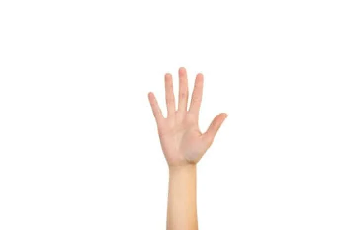  Dupuytren's contracture