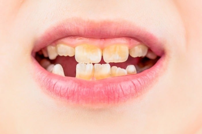 هیپوپلازی مینای دندان