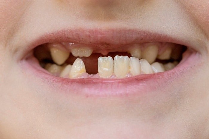 علائم تغییر رنگ دندان کودک