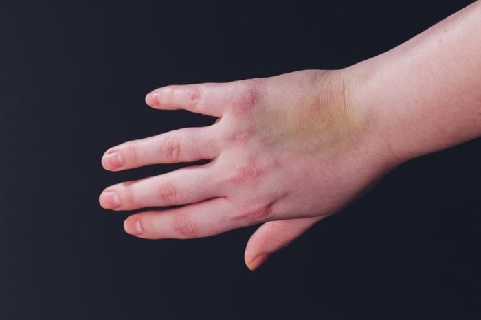 کبودی دست 