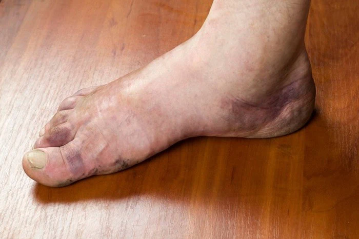 احتباس آب در بدن