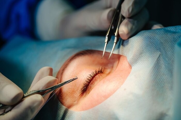جراحی چشم