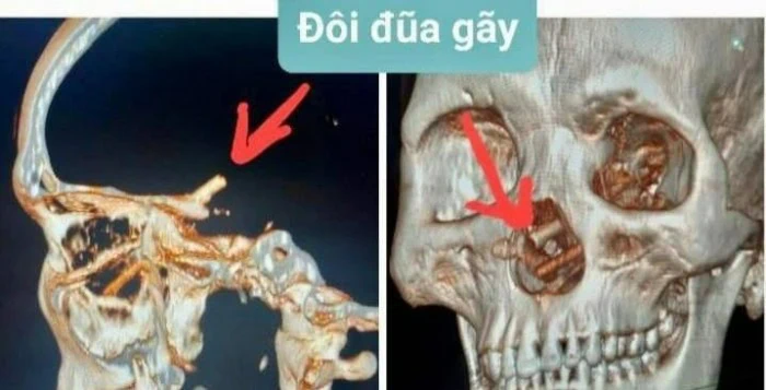 شئ عجیب داخل بینی
