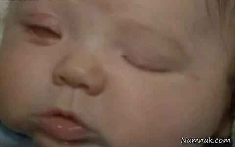تولد نوزادی بدون کره چشم