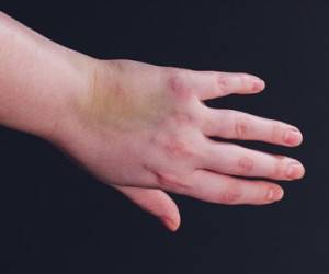 درمان کوفتگی انگشت دست
