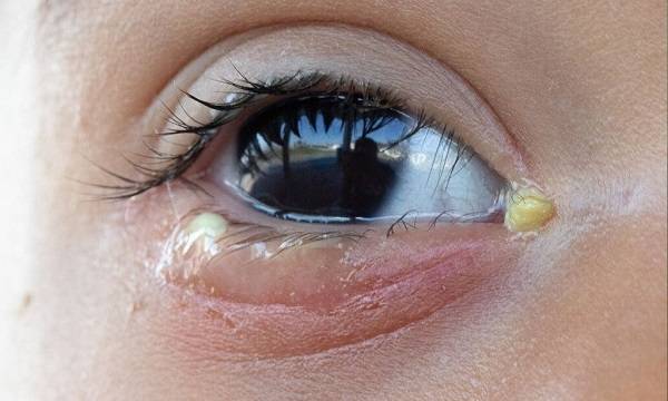 ترشحات چشمی و عواملی که باعث عفونت چشم می شود
