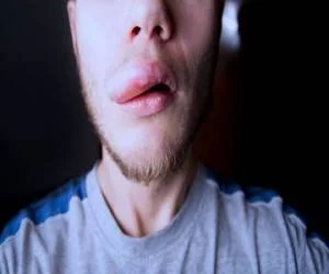 آنژیوادم ارثی