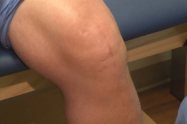 آب آوردن زانو 