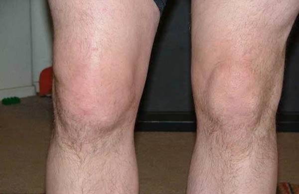 روش درمان ورم زانو