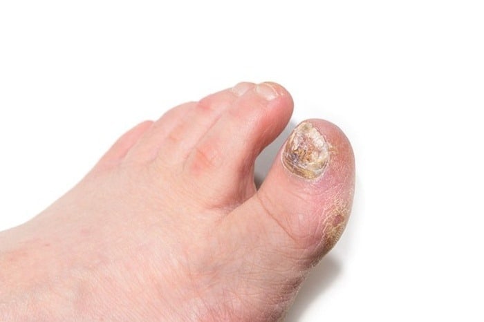 سرکه سیب برای قارچ ناخن قارچ ناخن انگشت پا