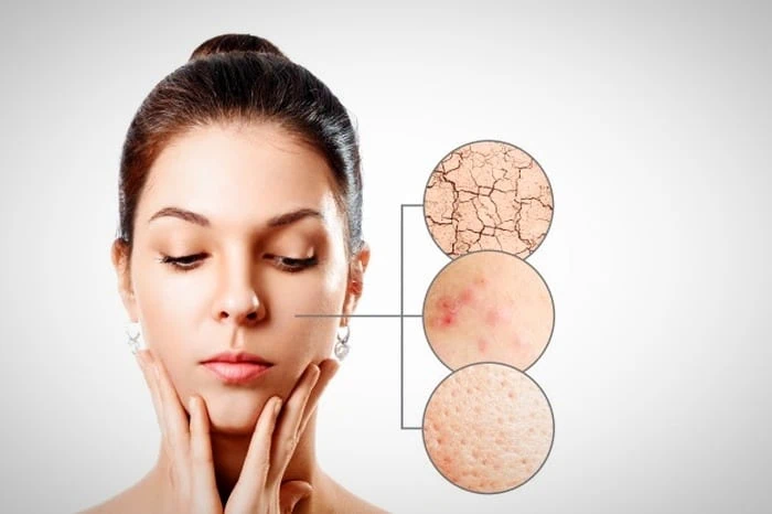 آفتاب سوختگی
