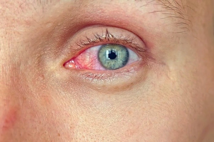 عفونت چشم 