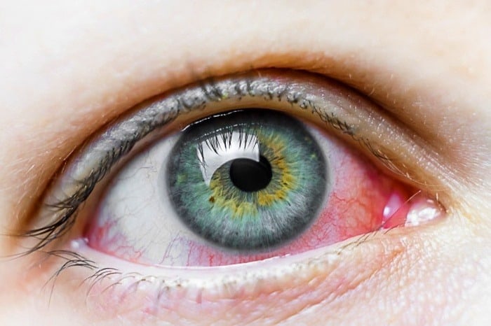 کاهش رگ های خونی چشم