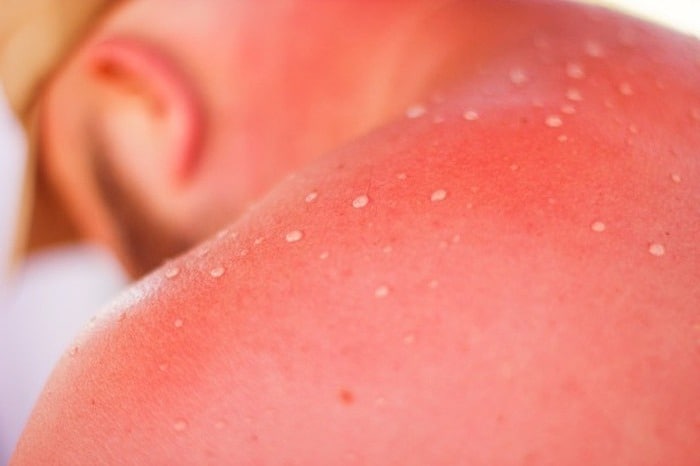 درمان آفتاب سوختگی گردن