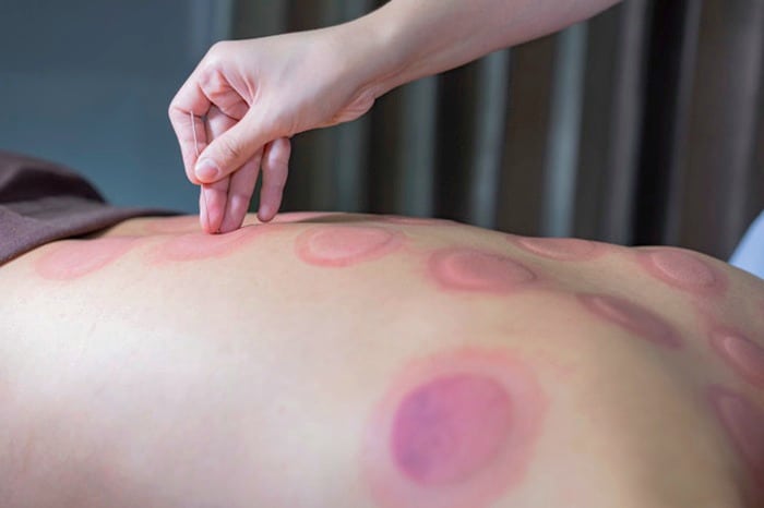 فواید بادکش درمانی همراه طب سوزنی بادکش درمانی همراه طب سوزنی