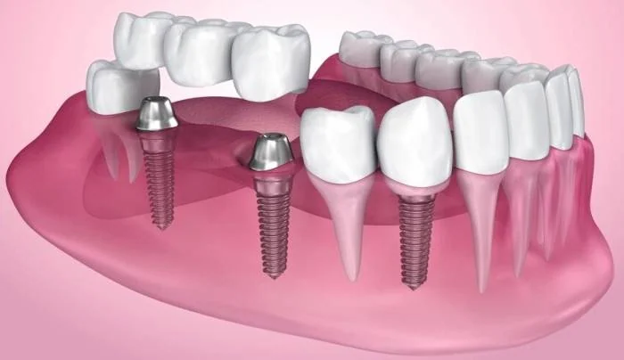 ایمپلنت کاشت دندان