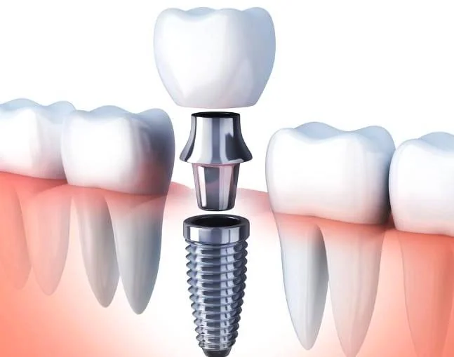 ایمپلنت کاشت دندان