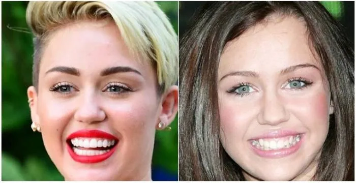 ایمپلنت کاشت دندان