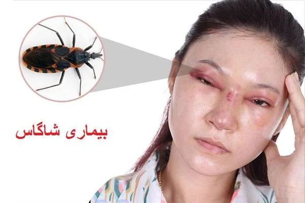بیماری شاگاس