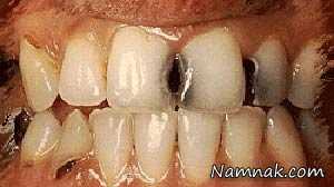پوسیدگی دندانها