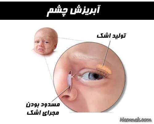 انسداد مجاری اشکی