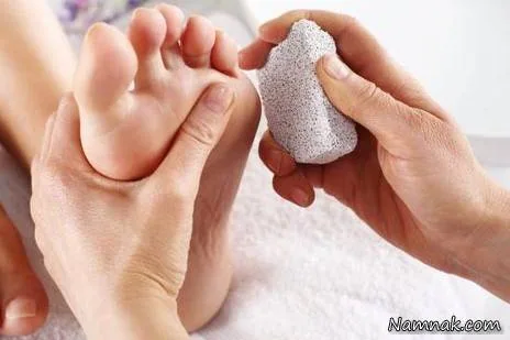 پوسته شدن پاشنه پا