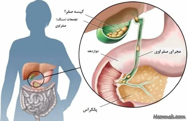 سنگ کیسه صفرا