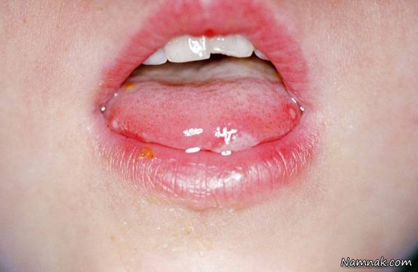 آفت دهان و زبان 