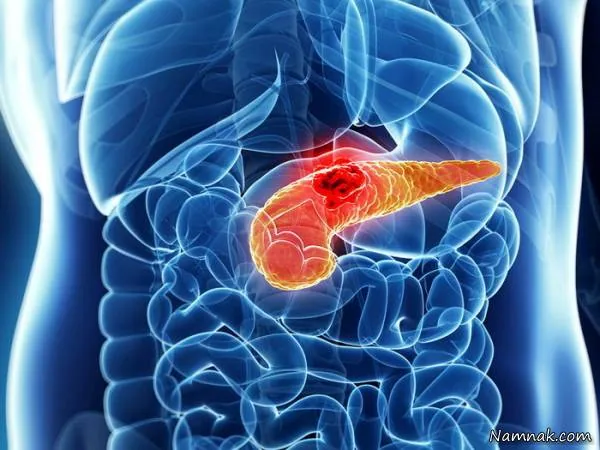 سرطان لوزالمعده یا پانکراس چه علائمی دارد؟ سرطان لوزالمعده