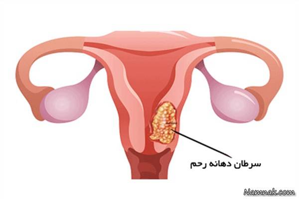 چگونه بفهمیم ویروس اچ پی وی داریم؟