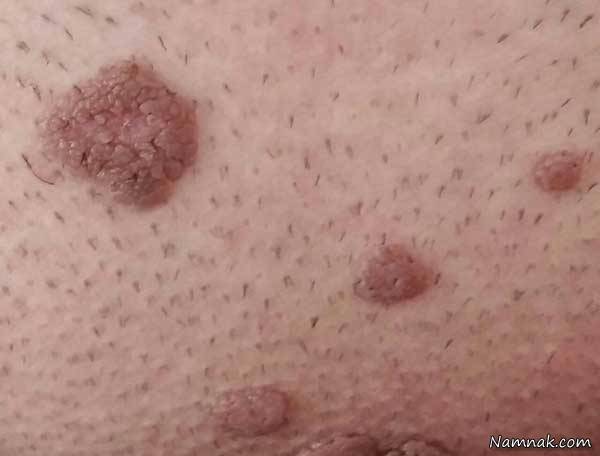 HPV اچ پی وی